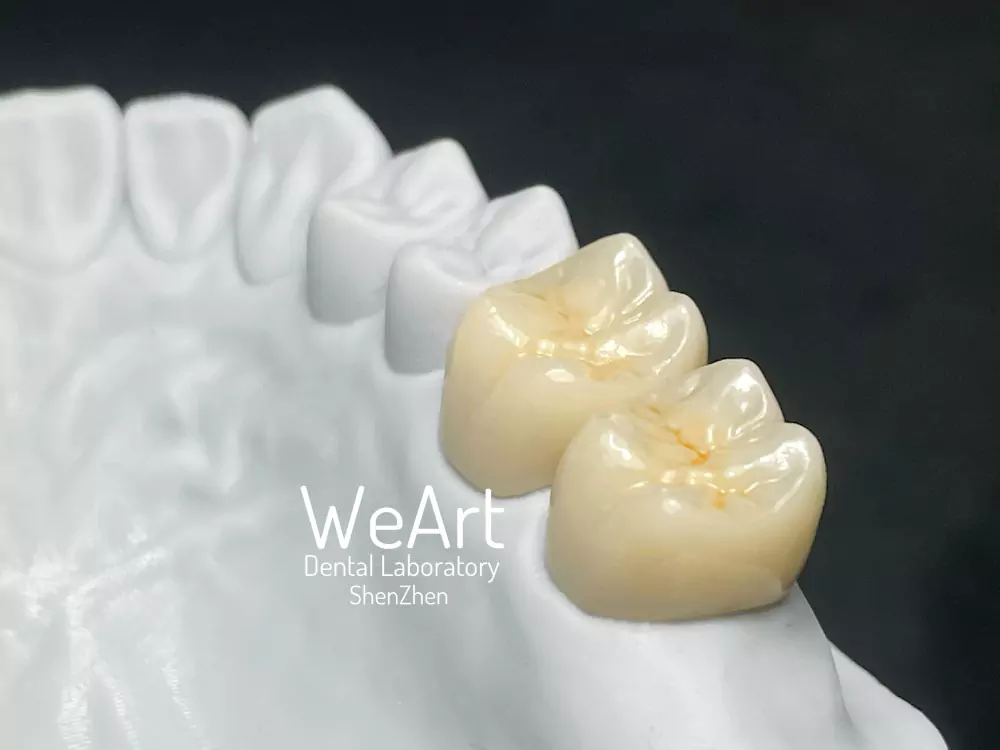 Is a Full Zirconia Crown the Ideal Solution for Durable, Aesthetic Dental Restorations?