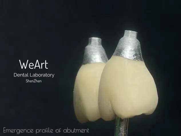 What Makes PFM Implant Crown a Reliable Choice for Modern Dental Restoration?