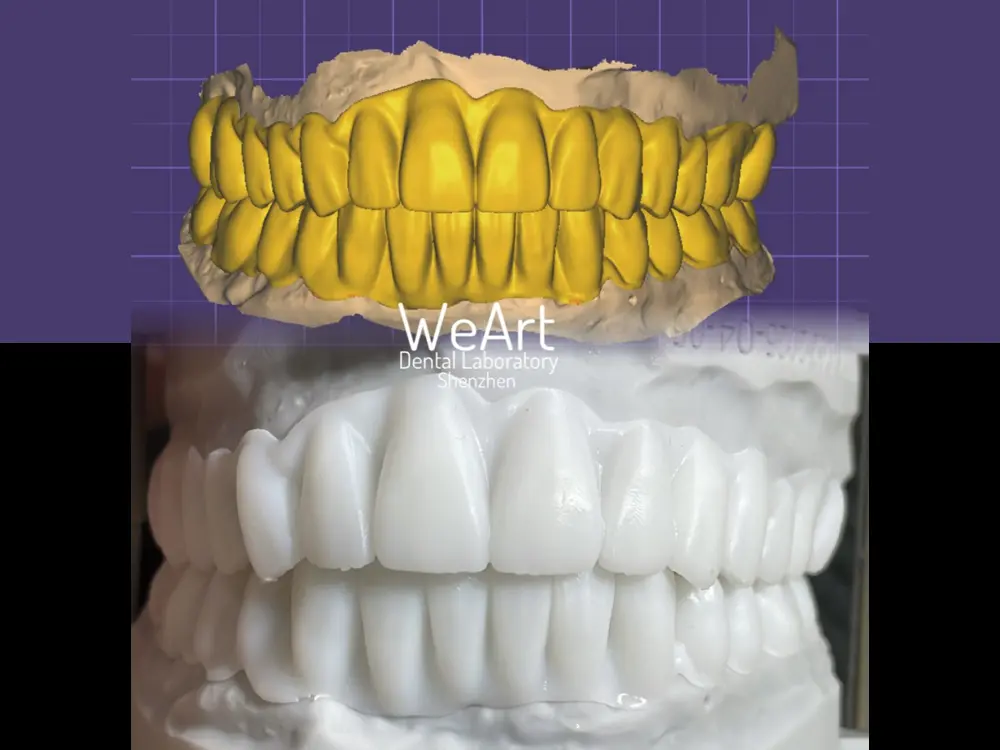 What Is a Temporary Crown and Why Is It Important for Modern Dental Restoration?