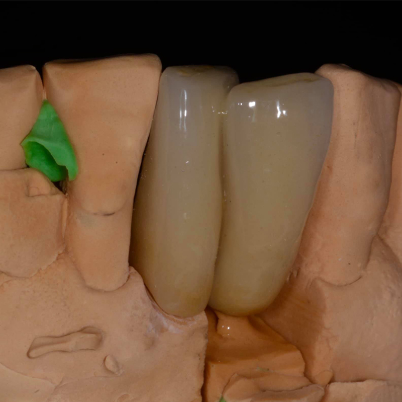 What Is a PFM Crown and Why Is It Still a Reliable Choice in Modern Dentistry?