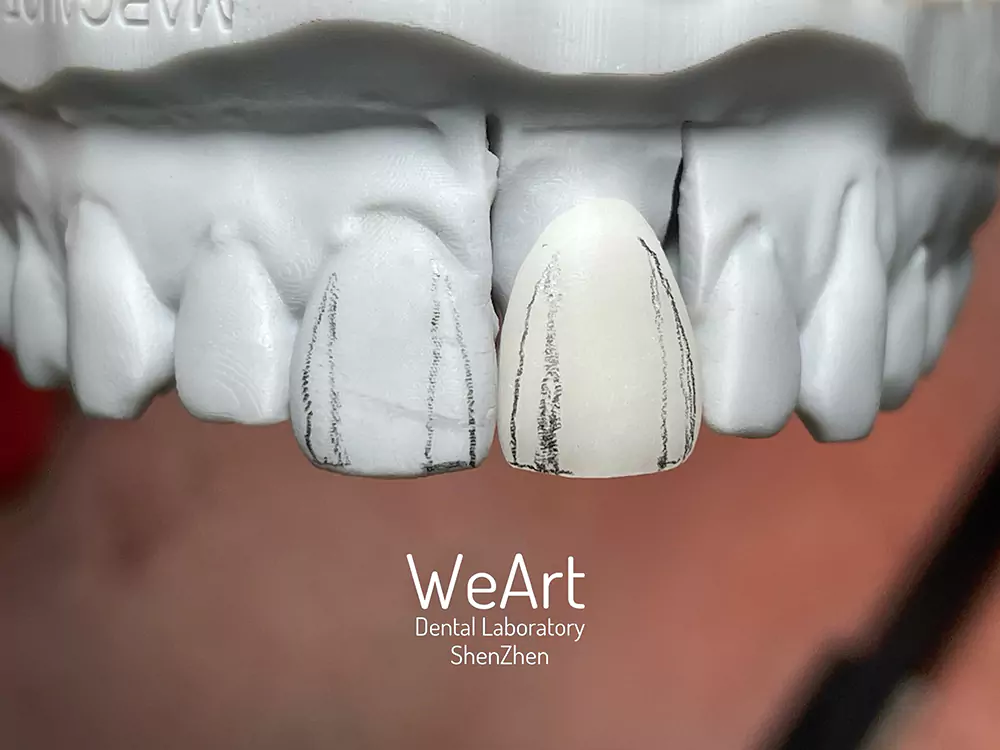 How Does IPS e.max Crown Improve Modern Dental Restorations?