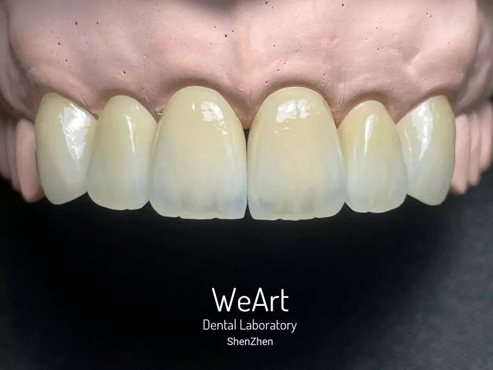 Zirconia Layered Porcelain Crown