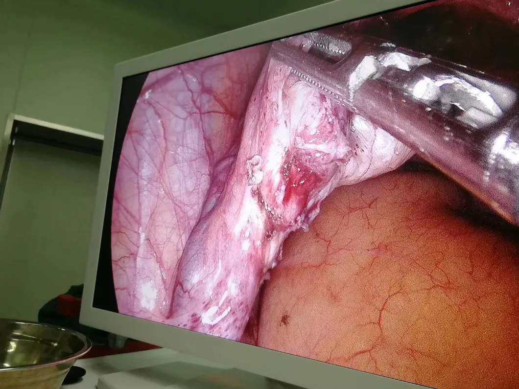 Medical HD Endoscopy System Laparoscope Endoscope Complete Set
