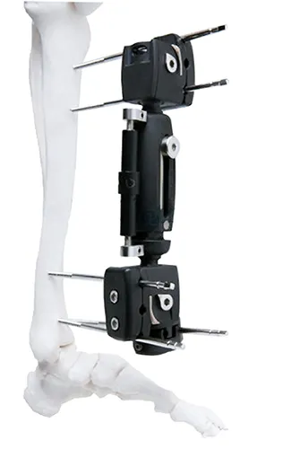 Xcaliber External Ortho Fix Radiolucent Tibia Fixator Sterile